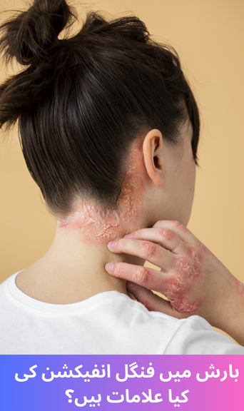 What are the symptoms of fungal infection in rain?